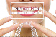 Выравнивание зубов с помощью элайнеров в клинике «Дантист» - 