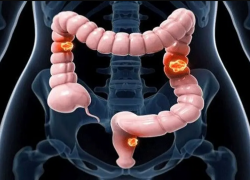 Коварный и смертоносный: 5 мифов о раке толстой кишки - их опровергли таганрогские врачи