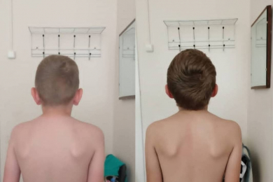 Остеопат Игорь Игоревич Брук. Лечение кривошеи у детей. - 