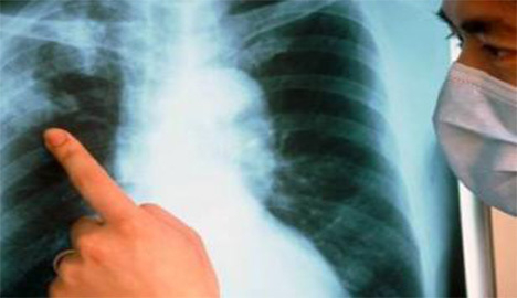 В Таганроге у троих украинцев обнаружили туберкулез