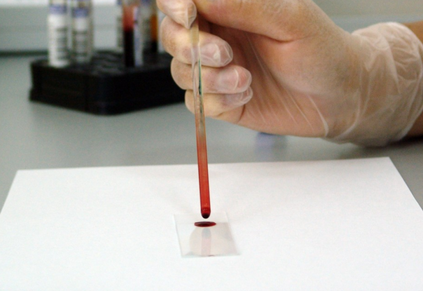 "Плохой» холестерин и холестериновые бляшки: популярный миф развенчали таганрогские врачи